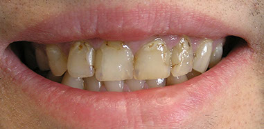 tooth wear and dental erosion